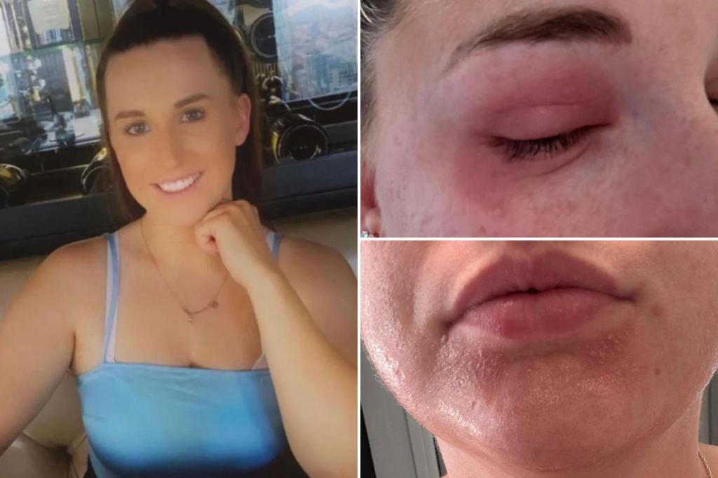 I developed a rare condition that made me allergic to my menstrual cycle
